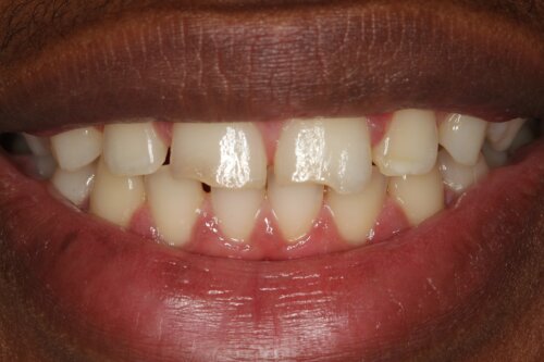 Cosmetic bonding before 1