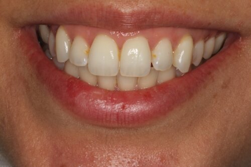 Cosmetic bonding before 13