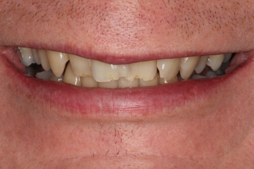 Cosmetic bonding before 15