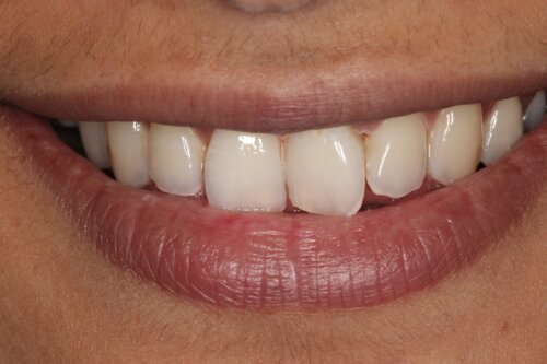 Cosmetic bonding before 19