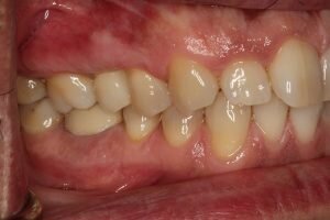 Dental Implant After lateral 300x200