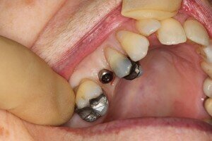 Dental implant placed using Laser 300x200