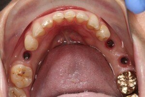 Dental implants in situ 300x200