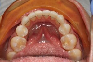 Fixed retainer 300x200