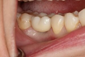Implant crown 300x200