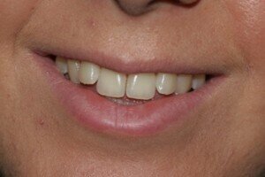 Initial smiling 300x200