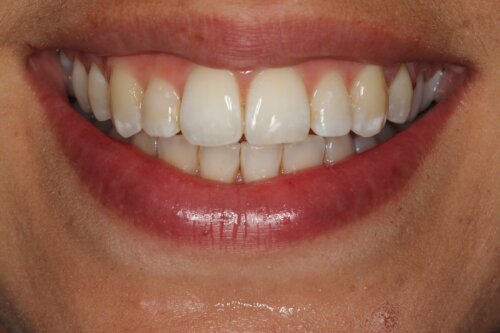 Lingual Braces After 3