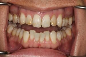 Lower crooked teeth 300x200ds