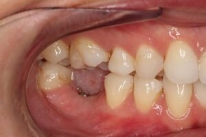 Missing molar tooth 300x200