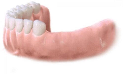 Multiple Implants Step 1