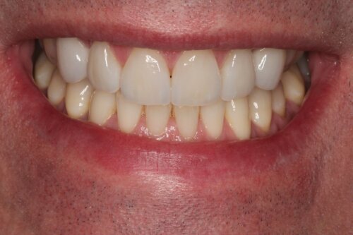 Porcelain veneers After 2