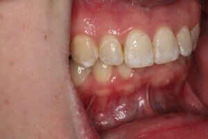 R Buccal after 300x200