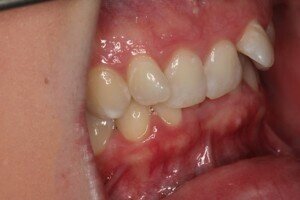 R Buccal before 300x200