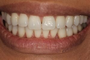 SM after lingual 300x200