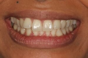 SM before lingual 300x200