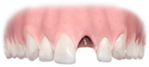 Single Tooth Implant Step 1
