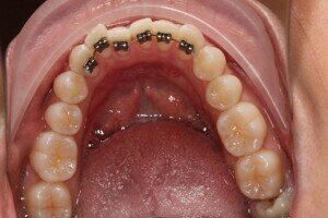 Social 6 brace 300x200rr