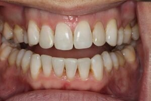 Straight lower teeth 300x200ds