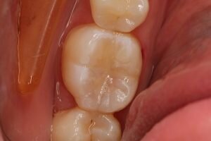 Waterlase decay after 300x200
