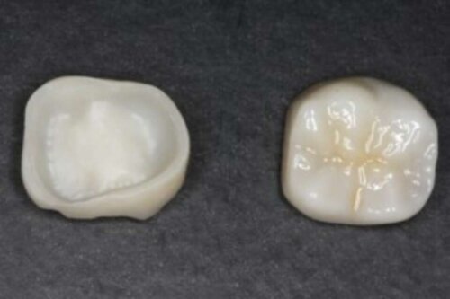 Zirconia crowns