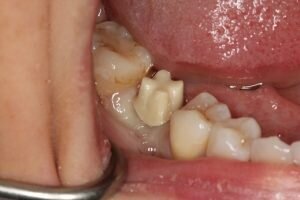 Zirconium abutment 300x200