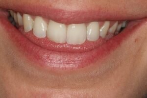 After Social 6 lingual brace 300x200 8