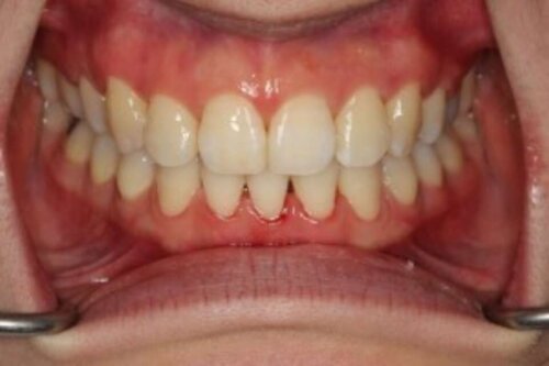 After ceramic orthodontic treatment