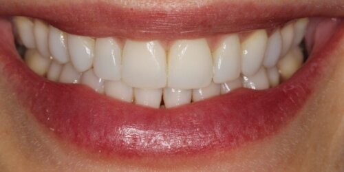 After cosmetic bonding 2022 08 16 130641 dkkk