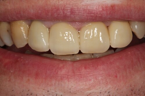 After crowns