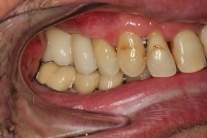 After dental implants right side 300x200