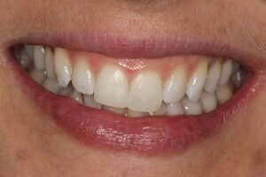 After lingual braces and bonding 300x200