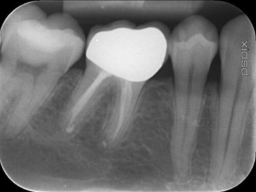 After root canal