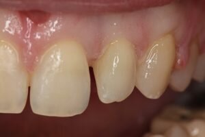 Before bonding 300x200