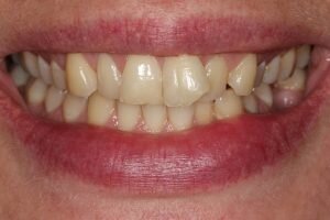 Before braces 300x200 2