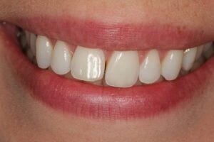 Before braces 300x200