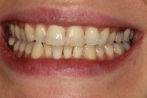 Before ceramic braces 300x200 9