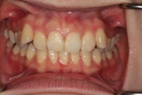 Before ceramic orthodontic treatment