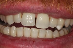 Before cosmetic bonding 300x200 7