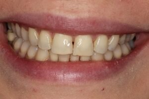 Before cosmetic bonding 300x200 9