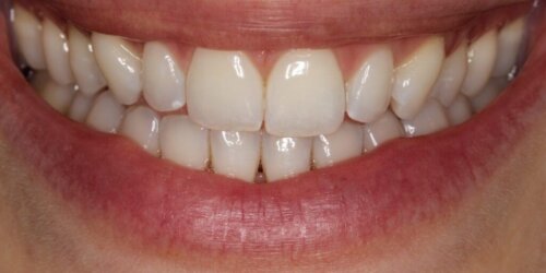 Before cosmetic bonding 2022 08 16 130610 iavd