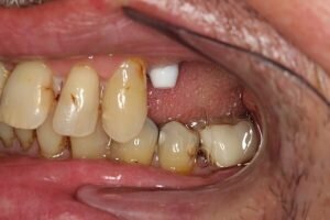 Before dental implants left side 300x200