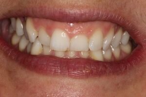 Before lingual braces and bonding 300x200