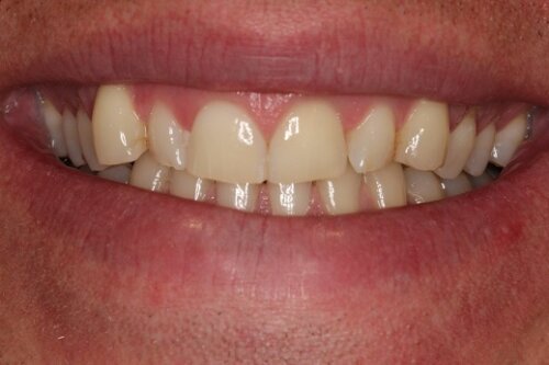 Before ortho and bonding