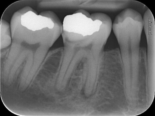 Before root canal