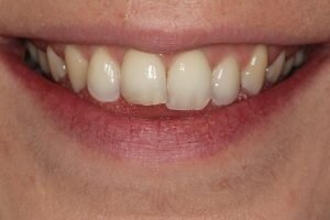 Before social 6 lingual brace 300x200 8