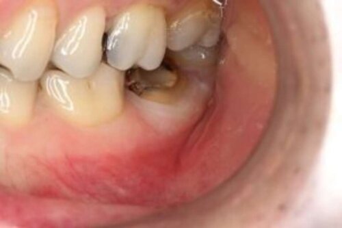 Broken down back tooth
