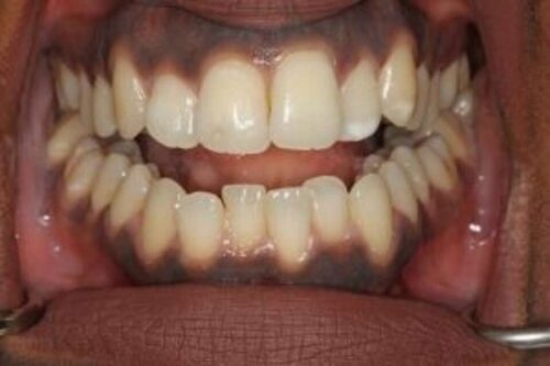 Crowded lower front teeth