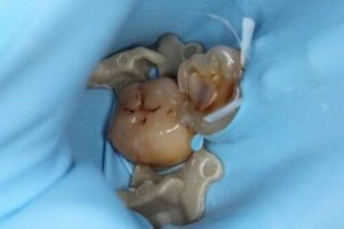Decayed broken molar teeth