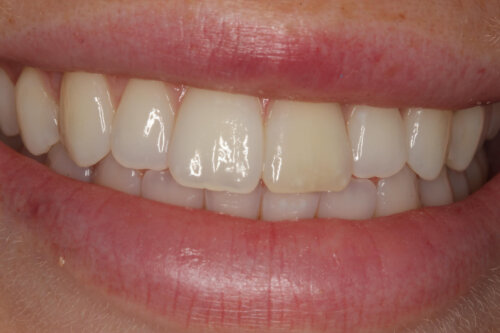 Discolouration of left central incisor