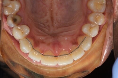 Fixed retainer